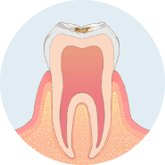 歯の表面に虫歯ができます