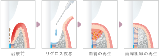 治療前→リグロス投与→血管の再生→歯周組織の再生