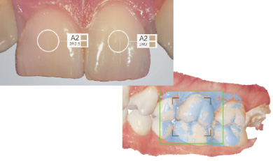 歯の色を測定 噛み合わせ自動採取