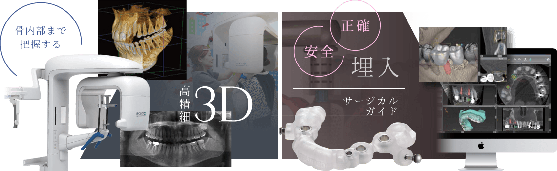 骨内部まで把握する3D 正確・安全埋入 サージカルガイド