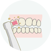 歯のクリーニングと自宅での使用方法を説明