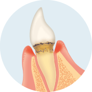 歯ぐきが腫れ、あごの骨が溶けはじめます