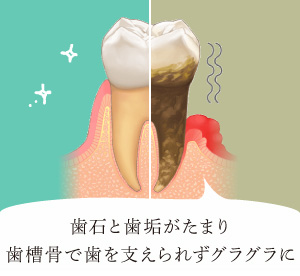 歯石と歯垢がたまり歯槽骨で歯を支えられずグラグラに